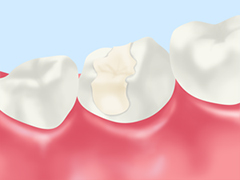 インレー（詰め物）