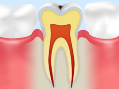 ごく初期のむし歯【CO】